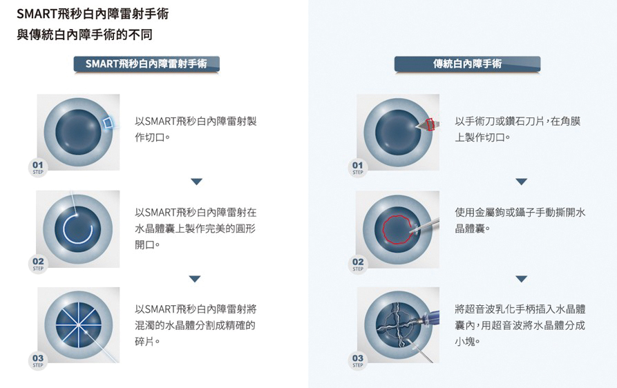 SMART飛秒白內障雷射手術與傳統白內障手術的不同資料來源smartsightcomtw